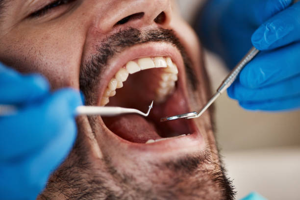 Best Emergency Wisdom Teeth Removal in St Cloud, MN